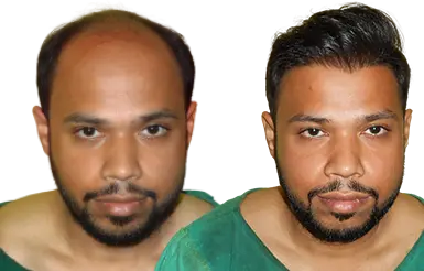 hair transplant before after images