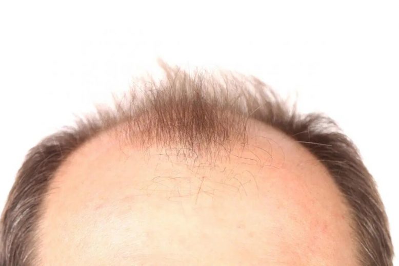 How can you inherit baldness genetically and whats the solution