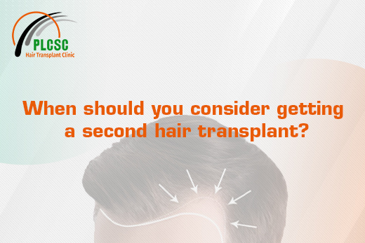 When should you consider getting a second hair transplant