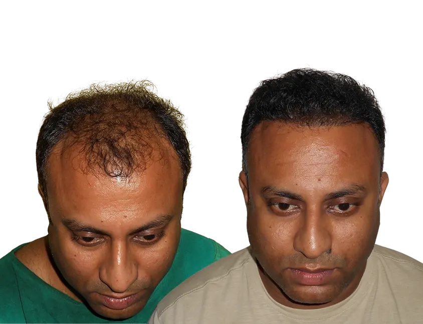 cost of hair transplant in kolkata plcsc