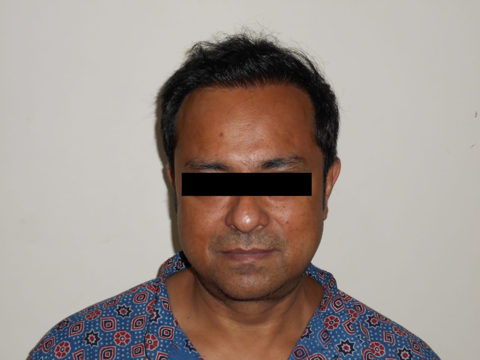 Image after hair transplant